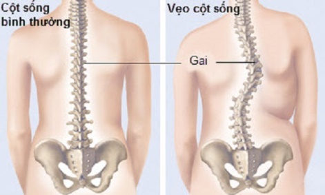 Phân tích dáng đi của người bị bệnh vẹo cột sống sử dụng đặc trưng HOG
