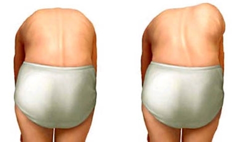 Phân tích dáng đi của người bị bệnh vẹo cột sống sử dụng đặc trưng HOG